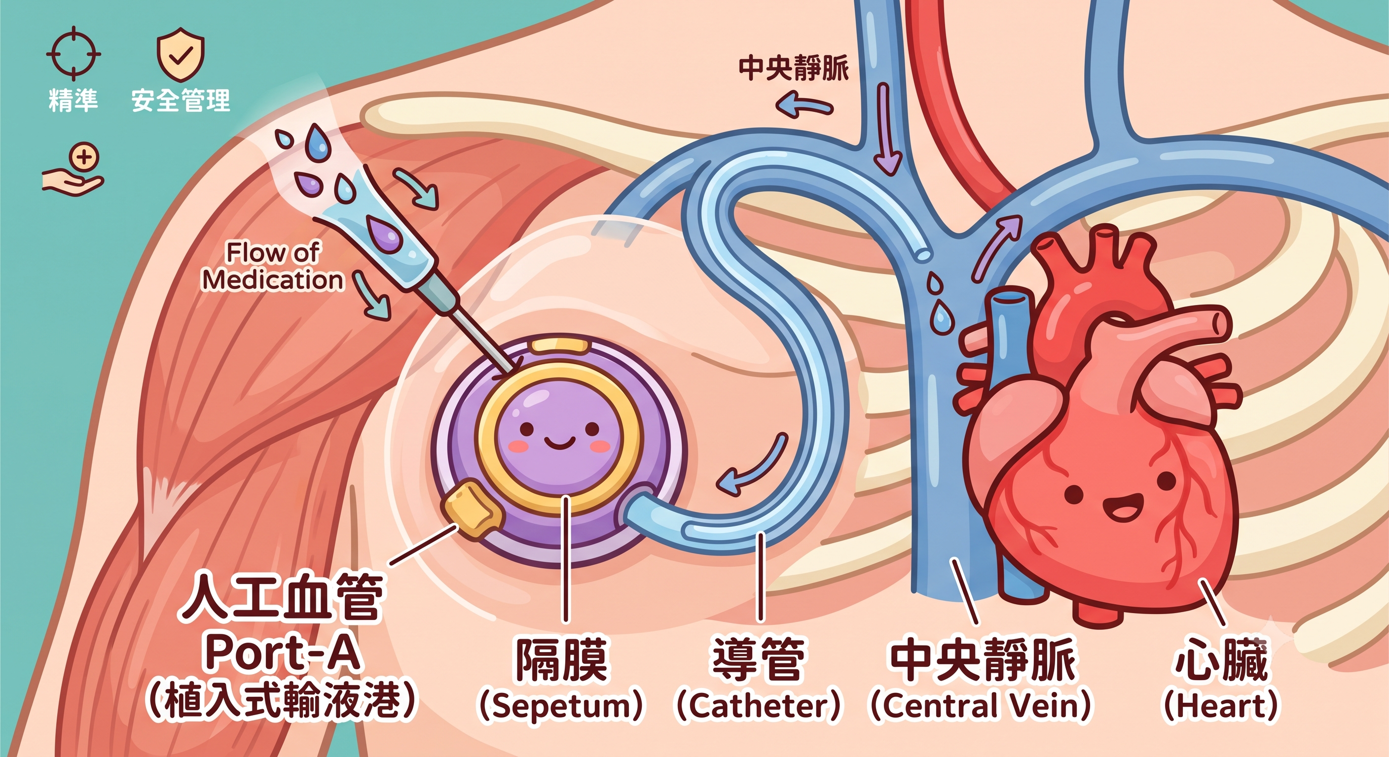 7月9日埋設人工血管(Port-A)